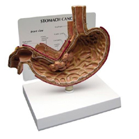 Stomach With Cancer Pharmaceutical and Anatomical Model Gifts